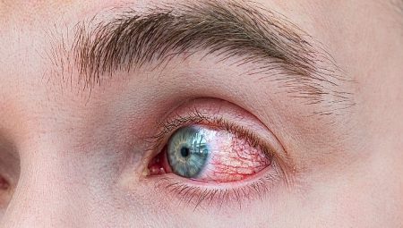 Bahar Alerjisinde Göz Ovalamak Körlüğe Yol Açıyor